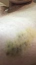 Vrouw blauw plekje, foto 576x1024, 3 reacties, 3 stemmen